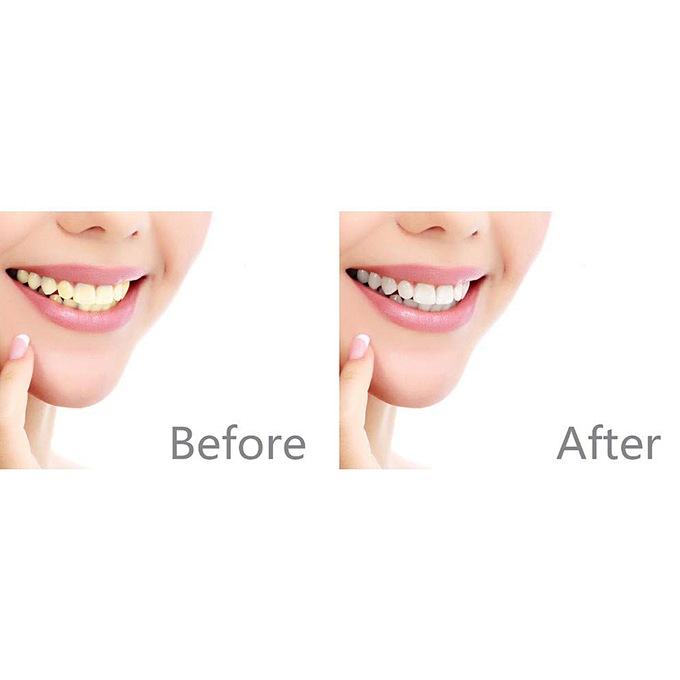 Total White 3-in-1 Teeth Ultrasonic Whitening System, , large