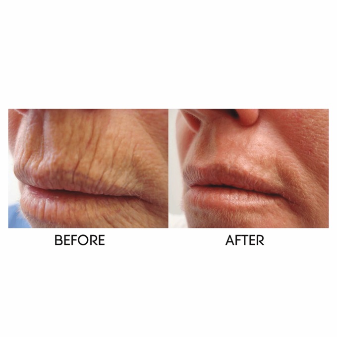 Lip Line Erasing Serum, , large